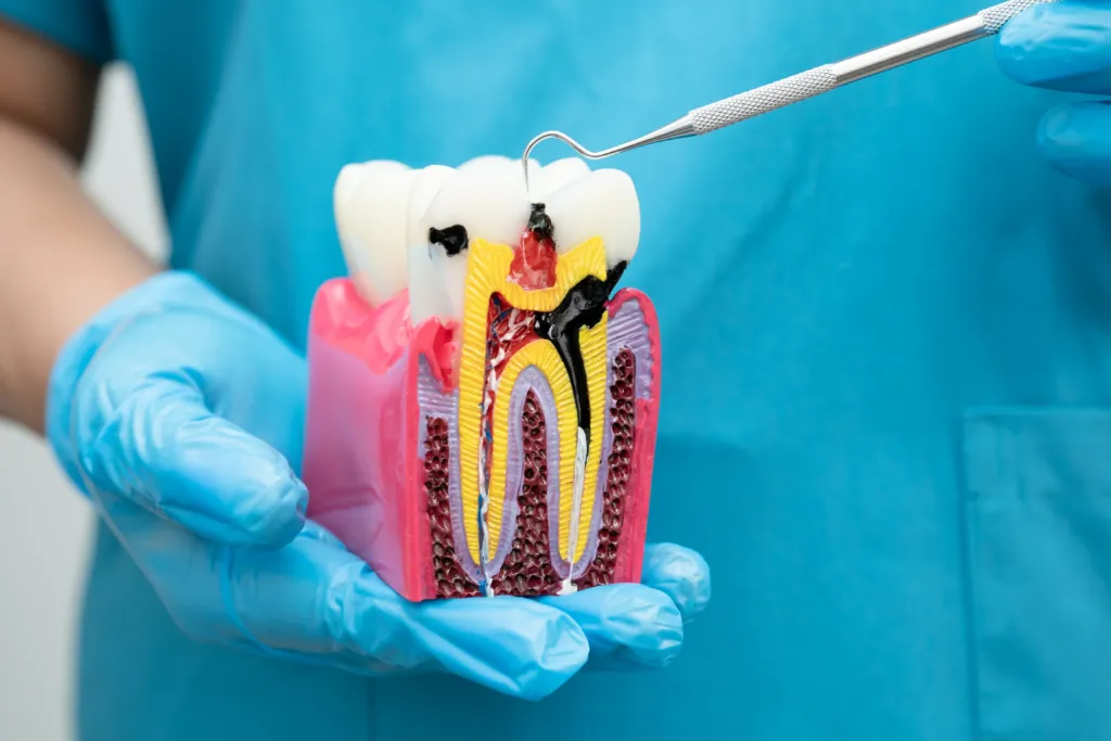 Endodonti (Kanal Tedavisi)