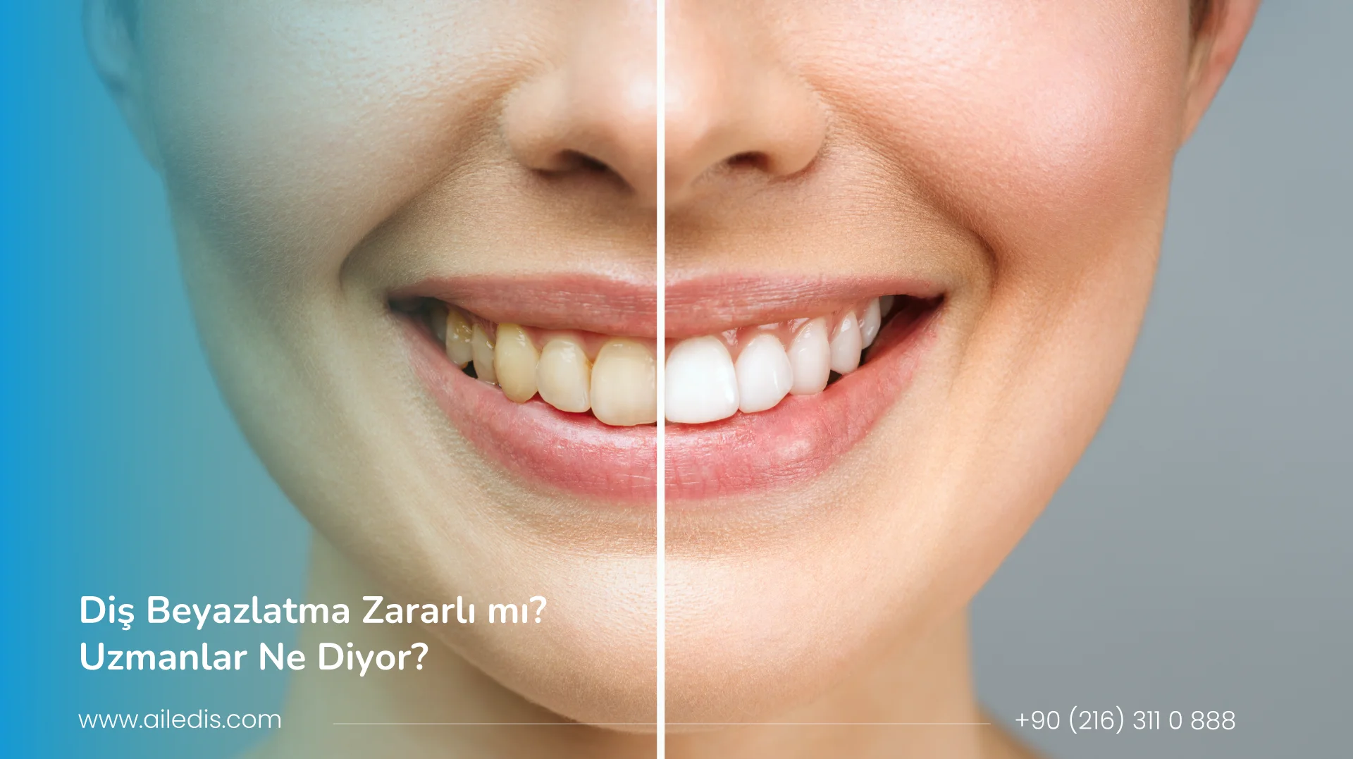 Diş Beyazlatma Zararlı mı