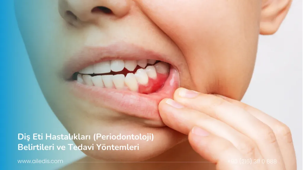 Diş Eti Hastalıkları