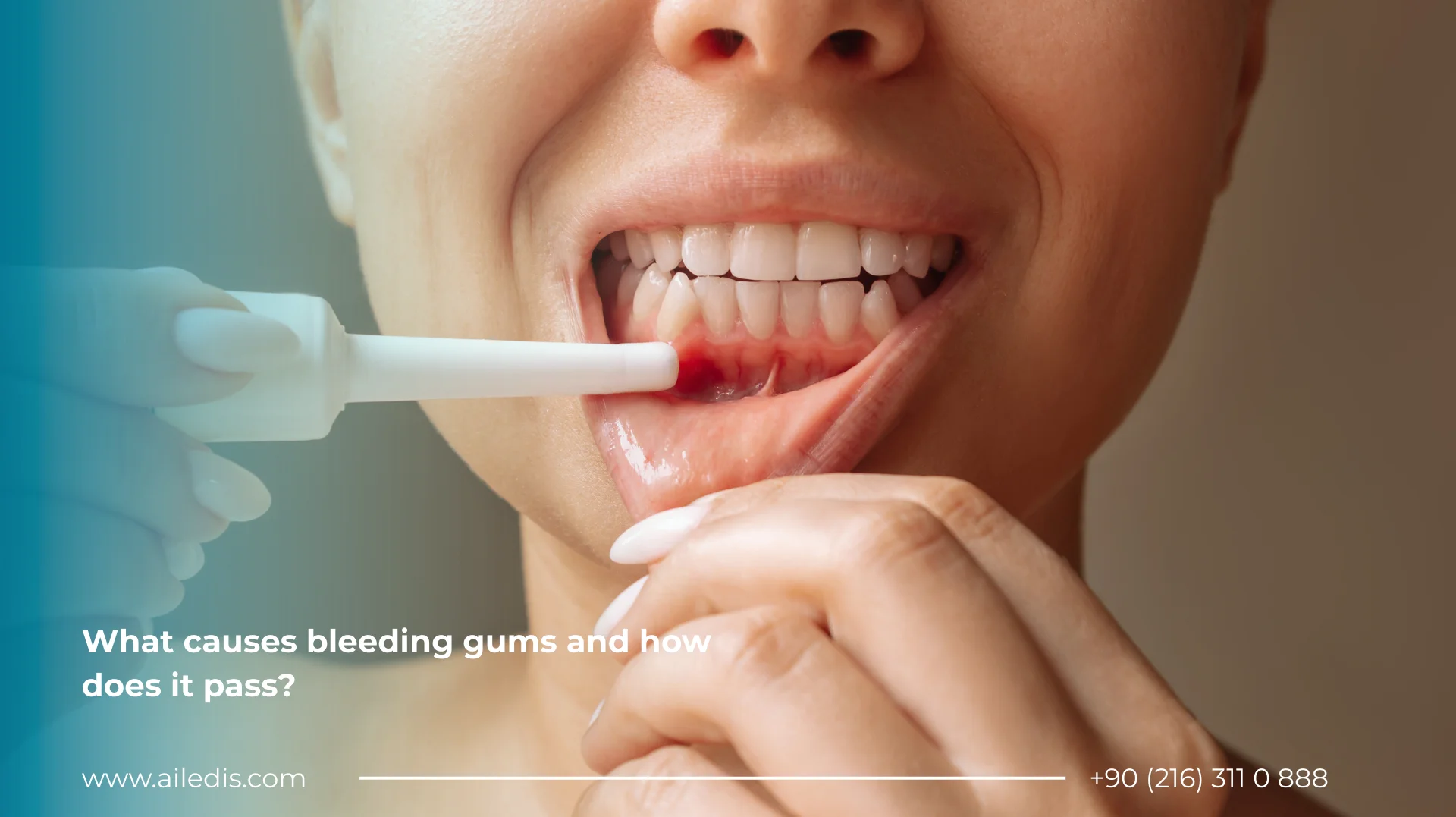 What causes bleeding gums and how does it pass?