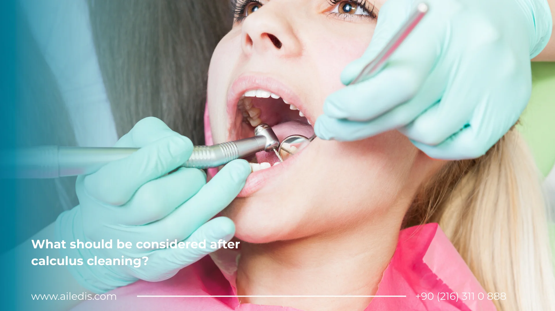 What should be considered after calculus cleaning?