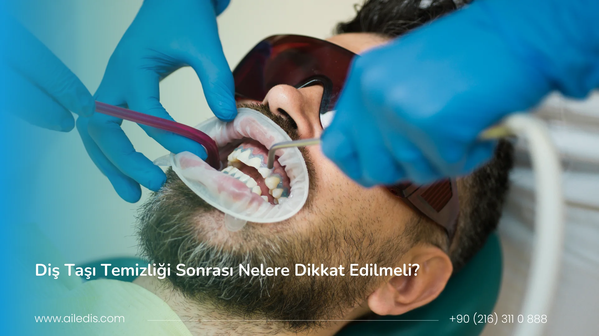 diş taşı temizliği sonrası