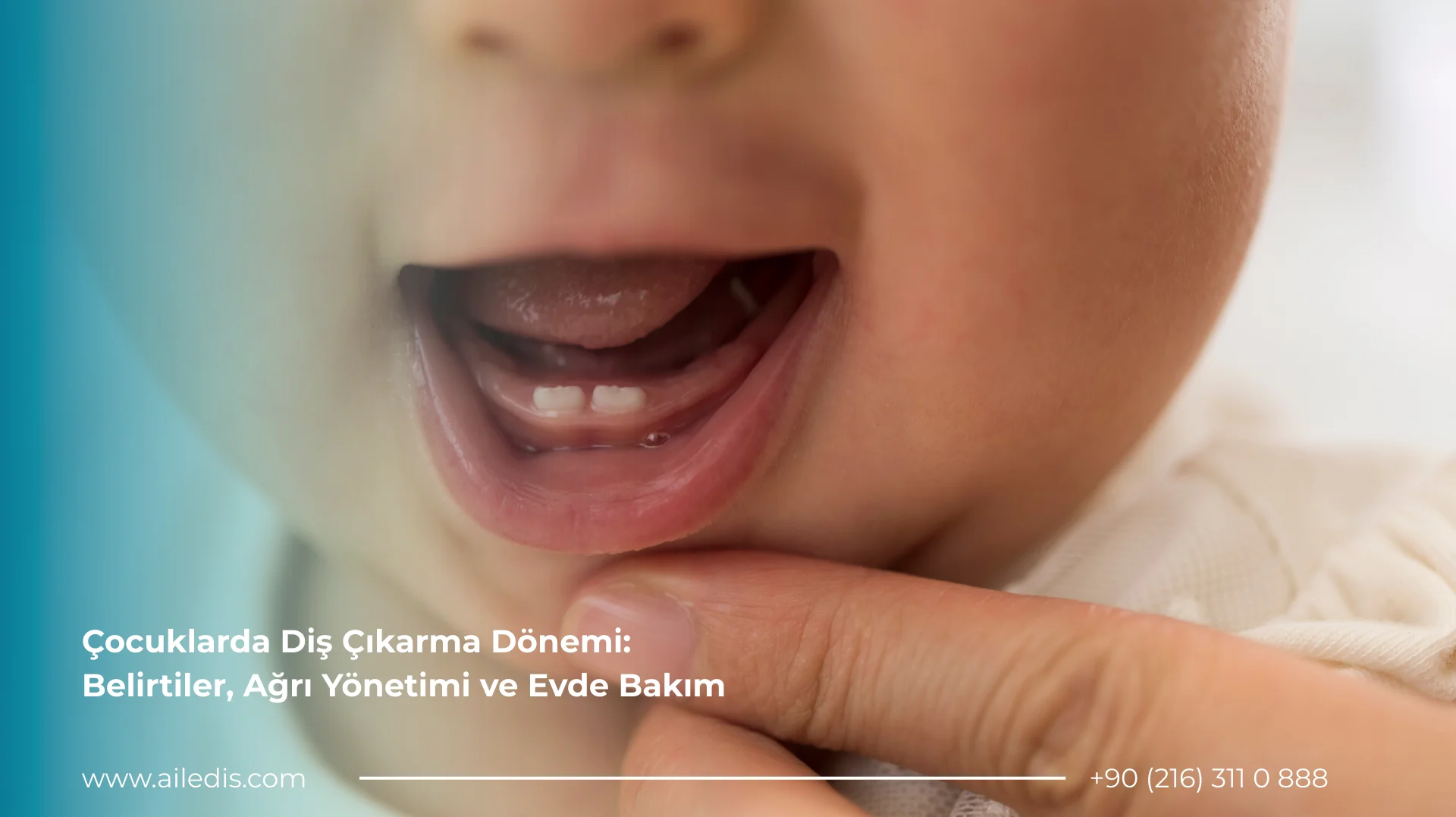 Çocuklarda Diş Çıkarma Dönemi