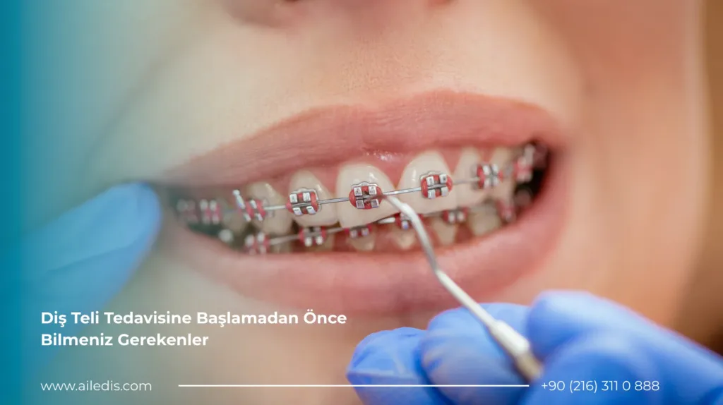 Diş Teli Tedavisine Başlamadan Önce Bilmeniz Gerekenler
