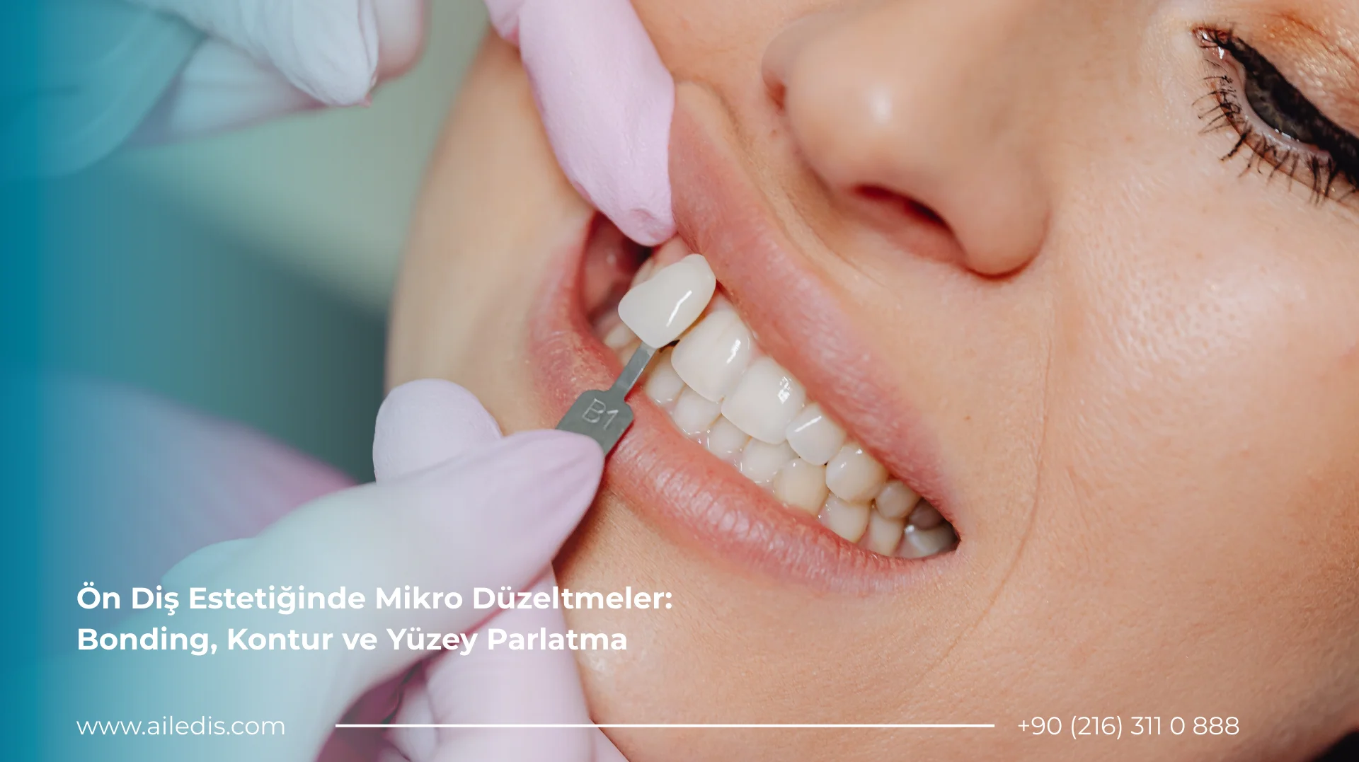 Ön Diş Estetiğinde Mikro Düzeltmeler