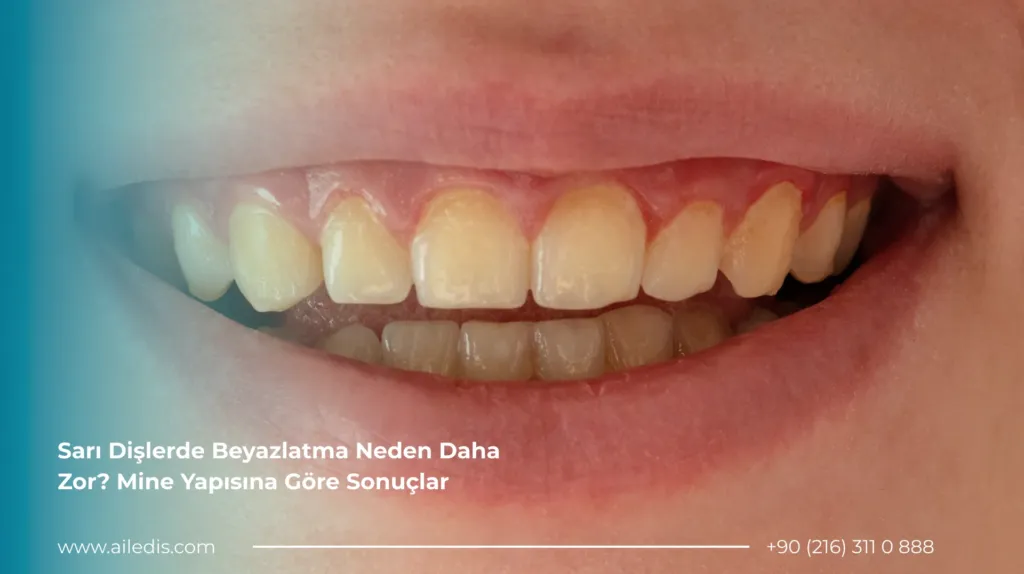 Sarı Dişlerde Beyazlatma Neden Daha Zor