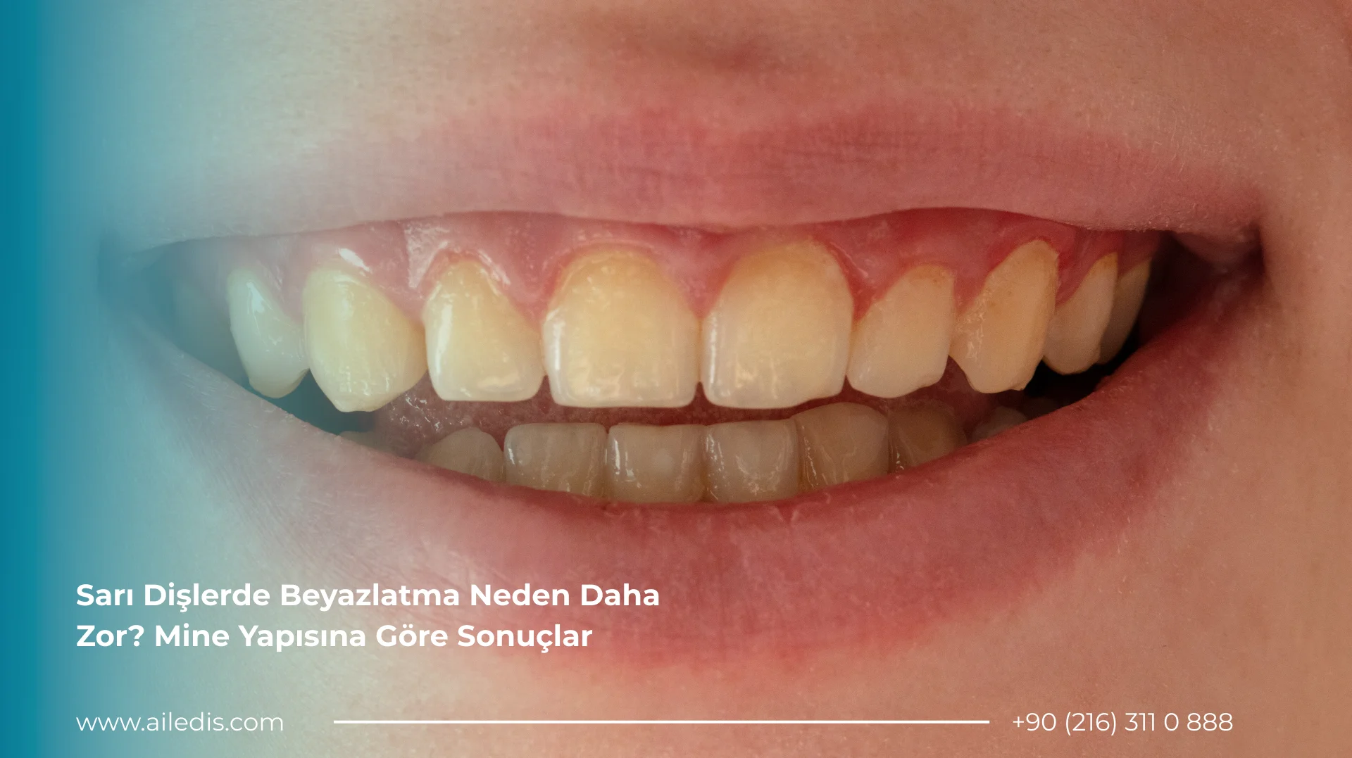 Sarı Dişlerde Beyazlatma Neden Daha Zor