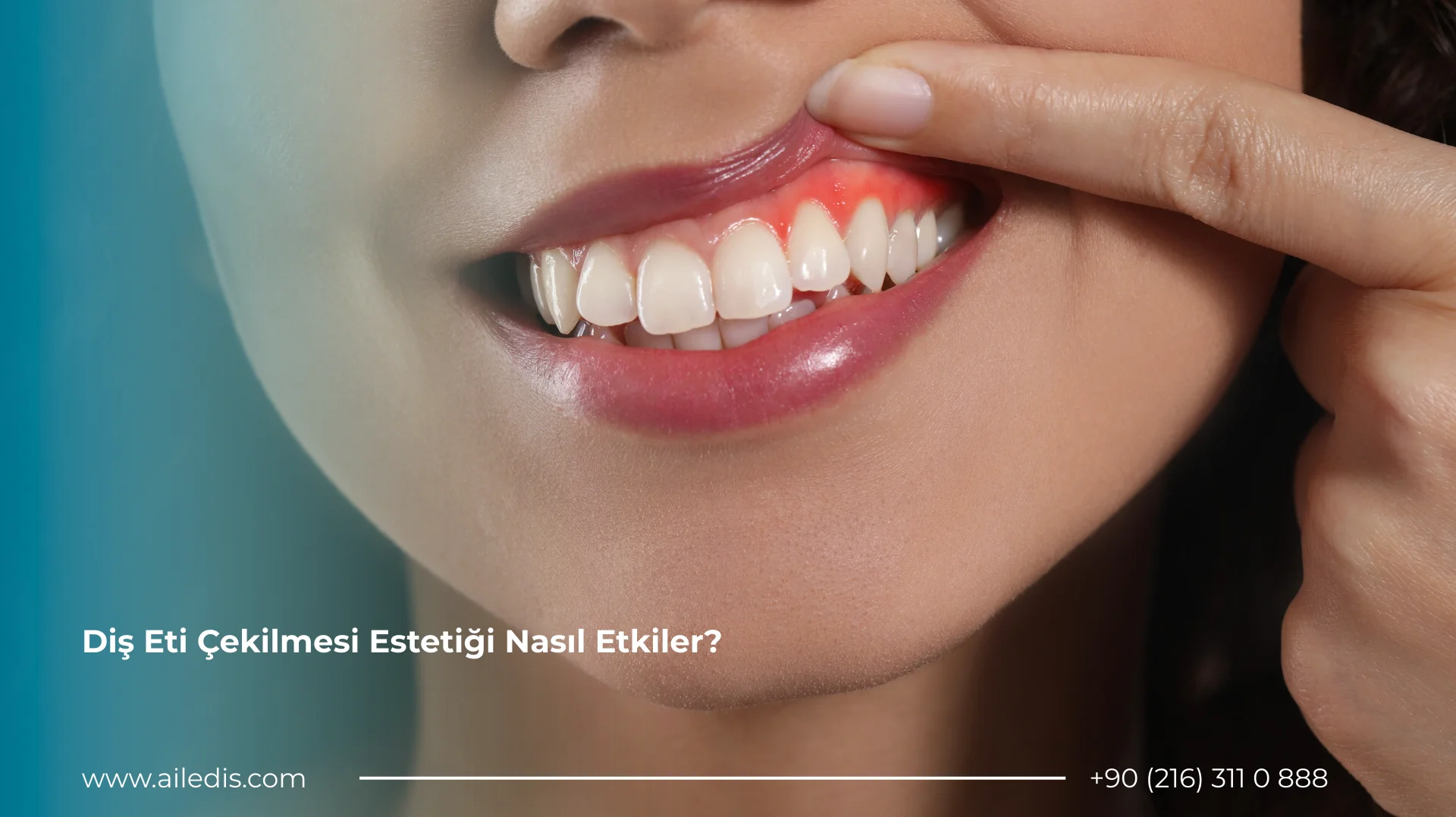 Diş Eti Çekilmesi Estetiği Nasıl Etkiler?