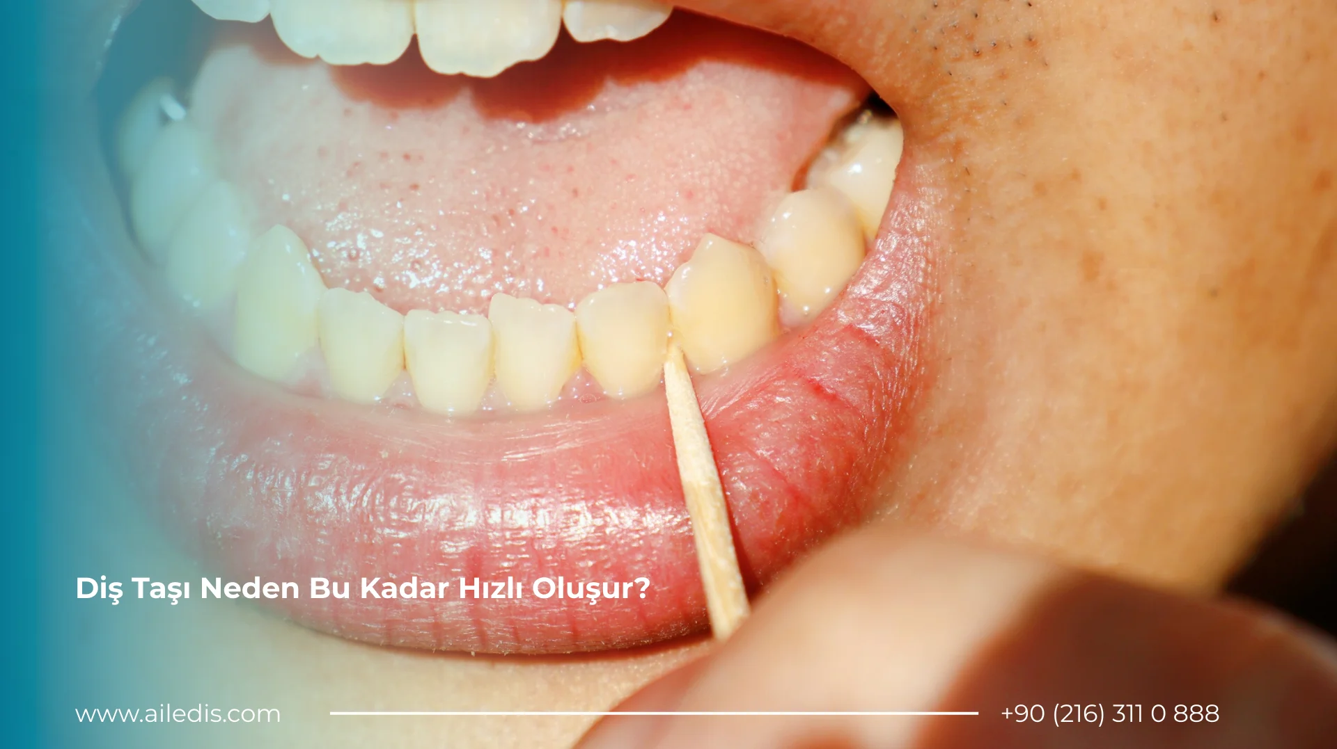 Diş Taşı Neden Bu Kadar Hızlı Oluşur?