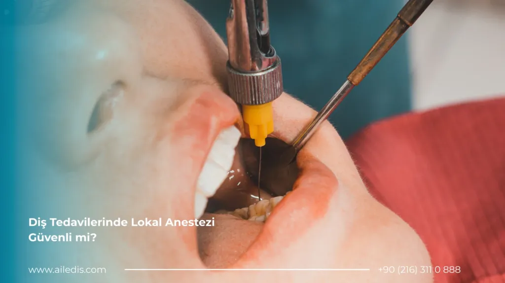 Diş Tedavilerinde Lokal Anestezi