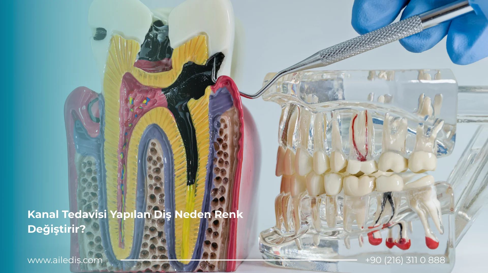 Kanal Tedavisi Yapılan Diş Neden Renk Değiştirir?