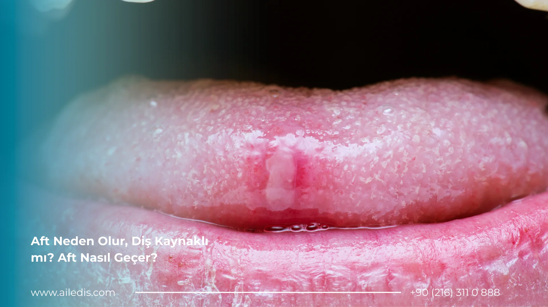 Aft Neden Olur, Diş Kaynaklı mı? Aft Nasıl Geçer?