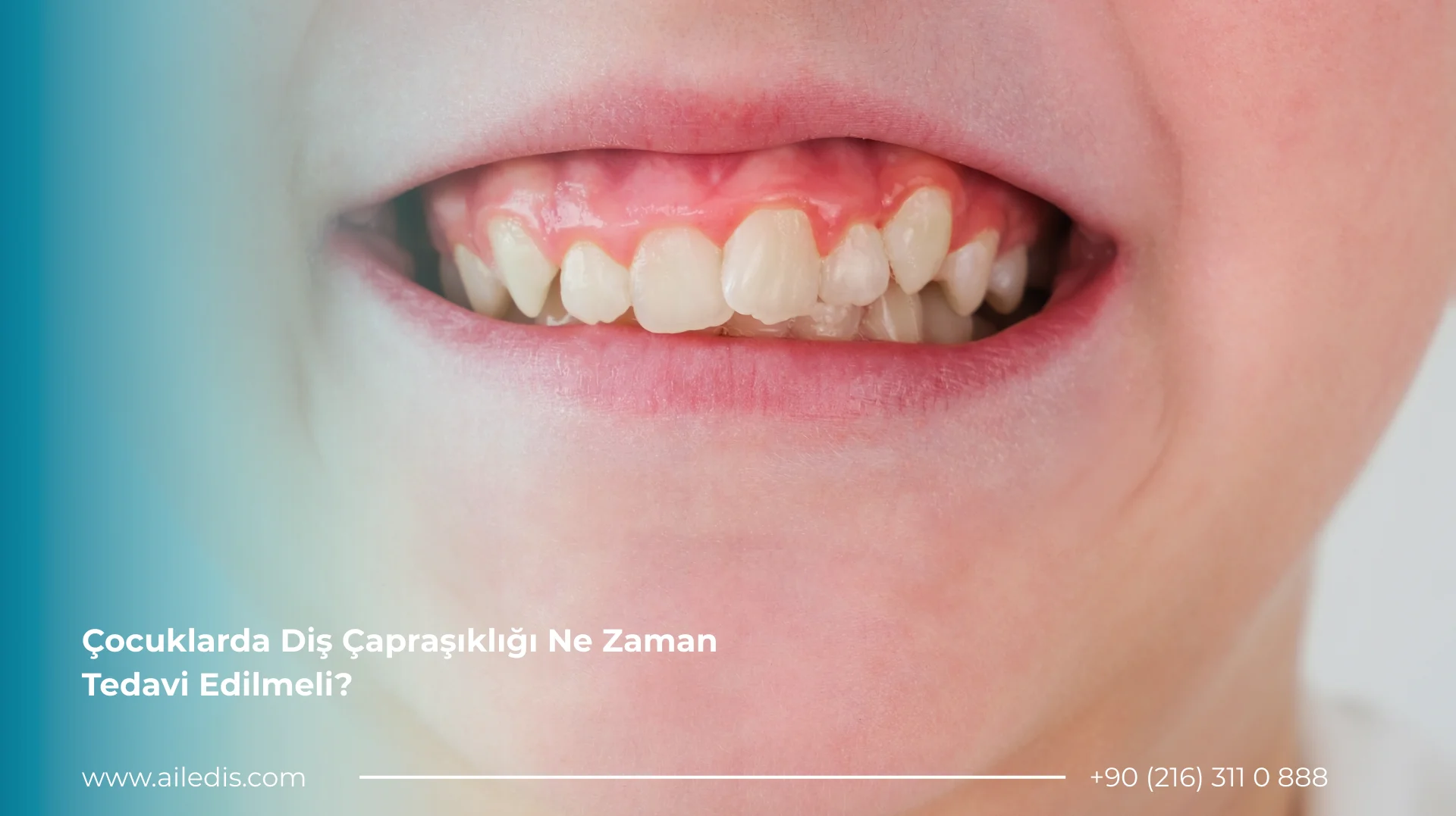 Çocuklarda Diş Çapraşıklığı