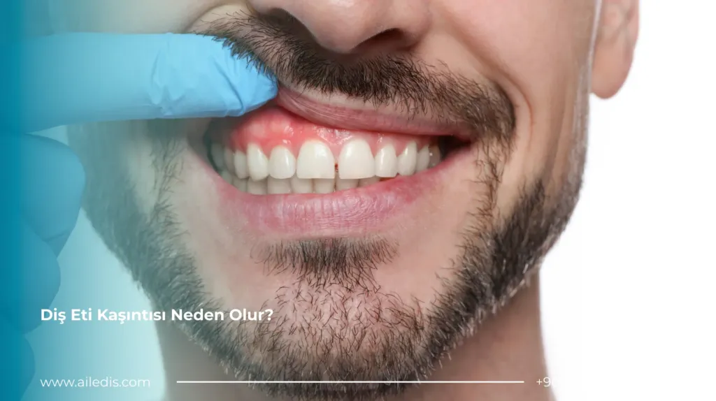 Diş Eti Kaşıntısı Neden Olur?