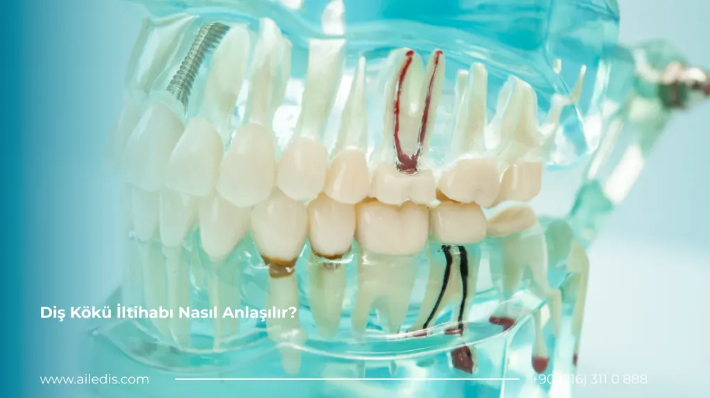 Diş Kökü İltihabı Nasıl Anlaşılır?