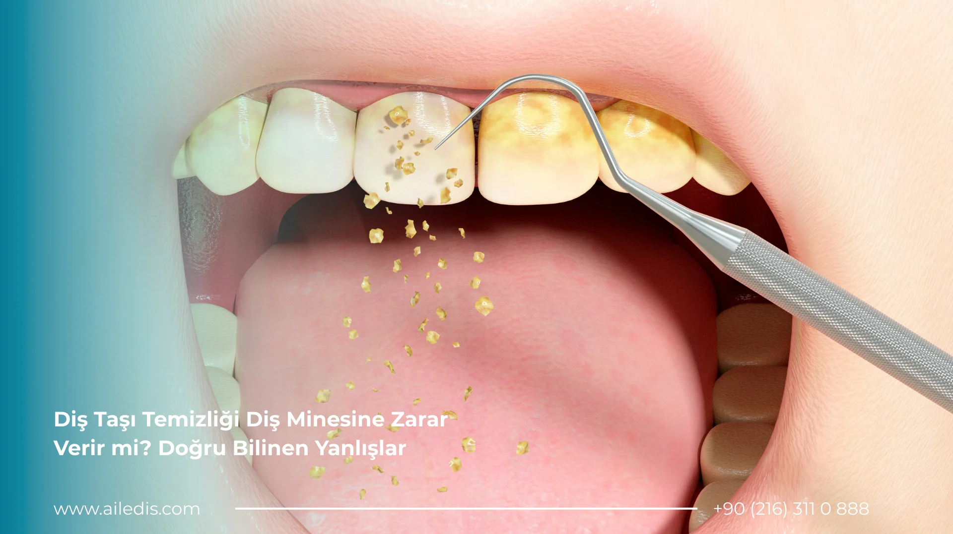 Diş Taşı Temizliği Diş Minesine Zarar Verir mi