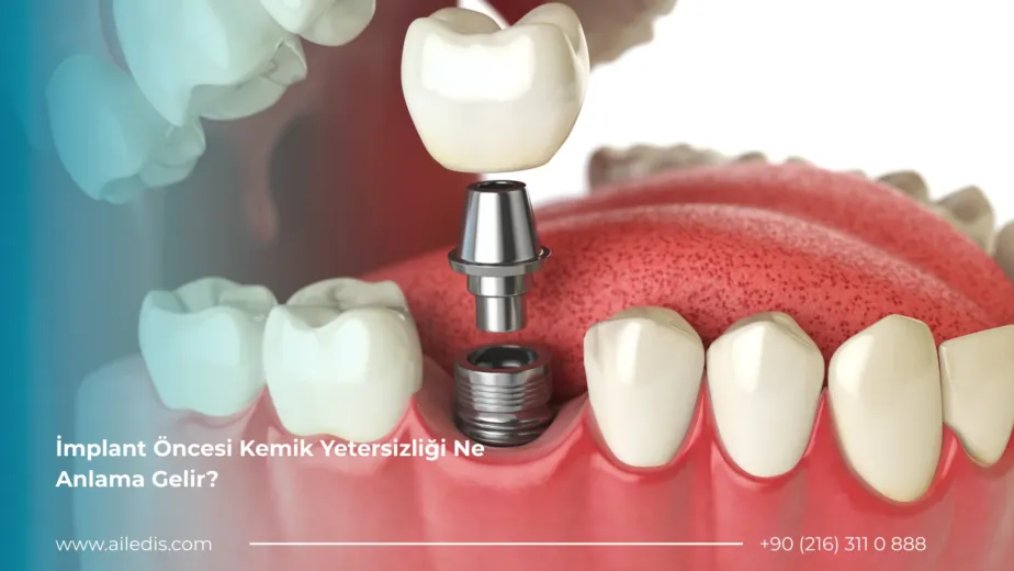 İmplant Öncesi Kemik Yetersizliği Ne Anlama Gelir