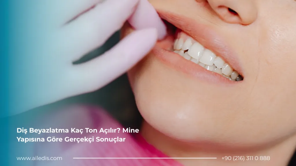 Diş Beyazlatma Kaç Ton Açılır Mine Yapısına Göre Sonuçlar