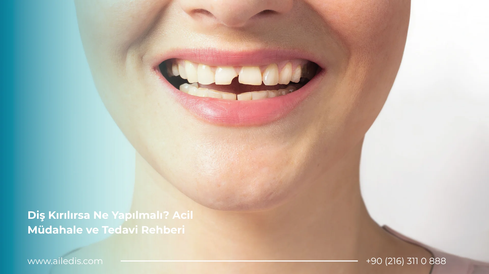 Diş Kırılırsa Ne Yapılmalı Acil Müdahale