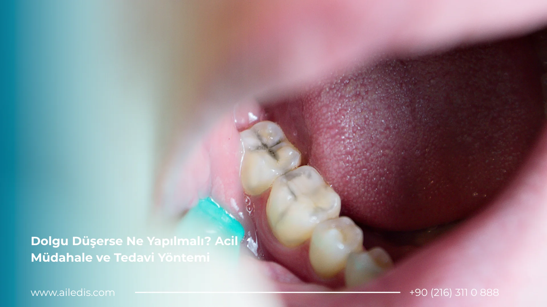 Dolgu düşerse ne yapılmalı