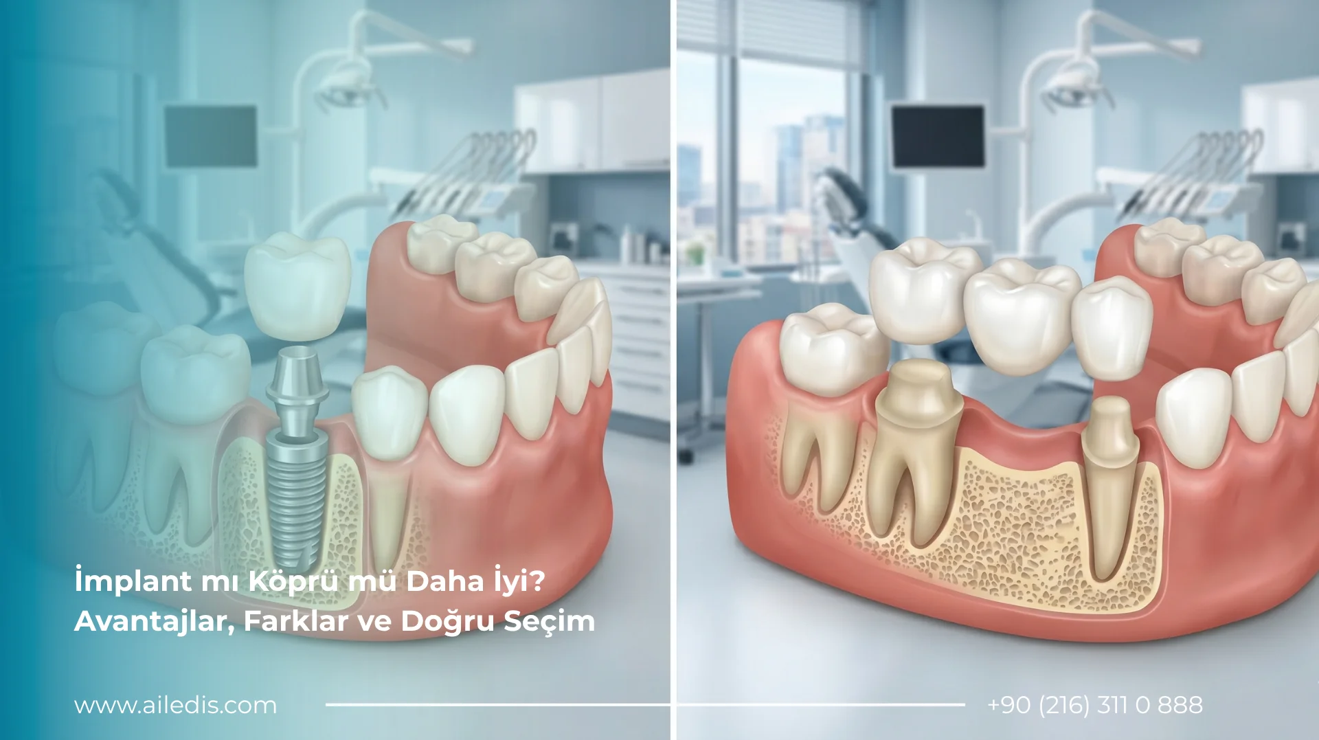 İmplant mı Köprü mü Daha İyi Avantajlar, Farklar ve Doğru Seçim