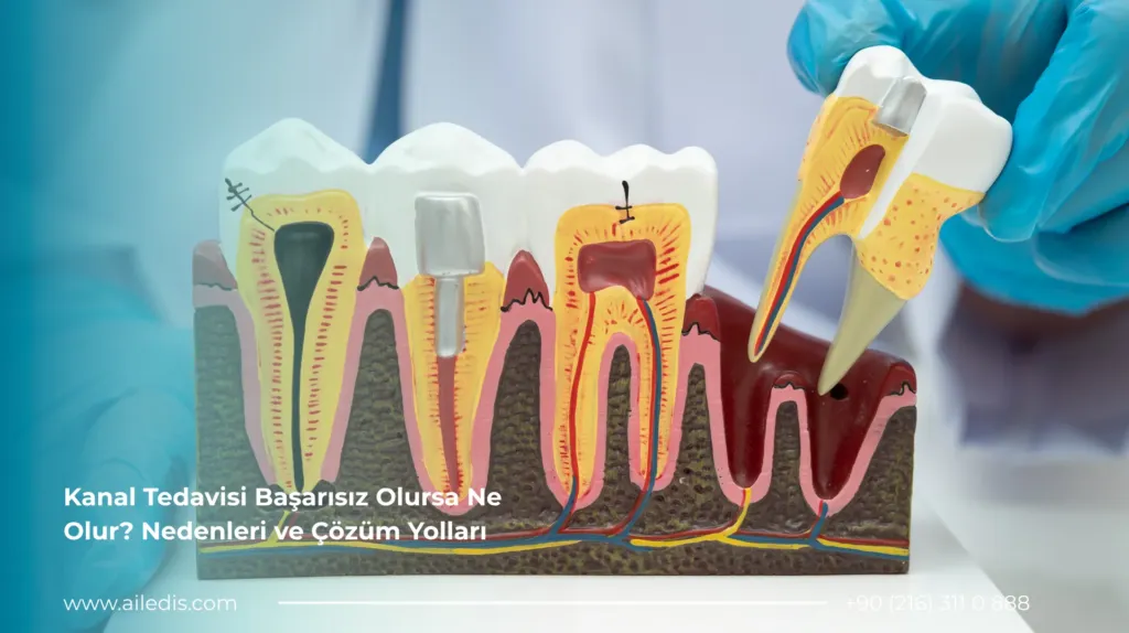Kanal Tedavisi Başarısız Olursa