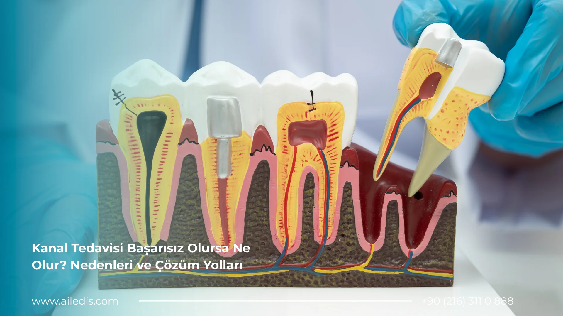 Kanal Tedavisi Başarısız Olursa